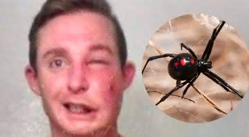 Homem quase perdeu a visão após ser picado por uma aranha da espécie Viúva Negra - Reprodução/Jam Press/DepositPhotos